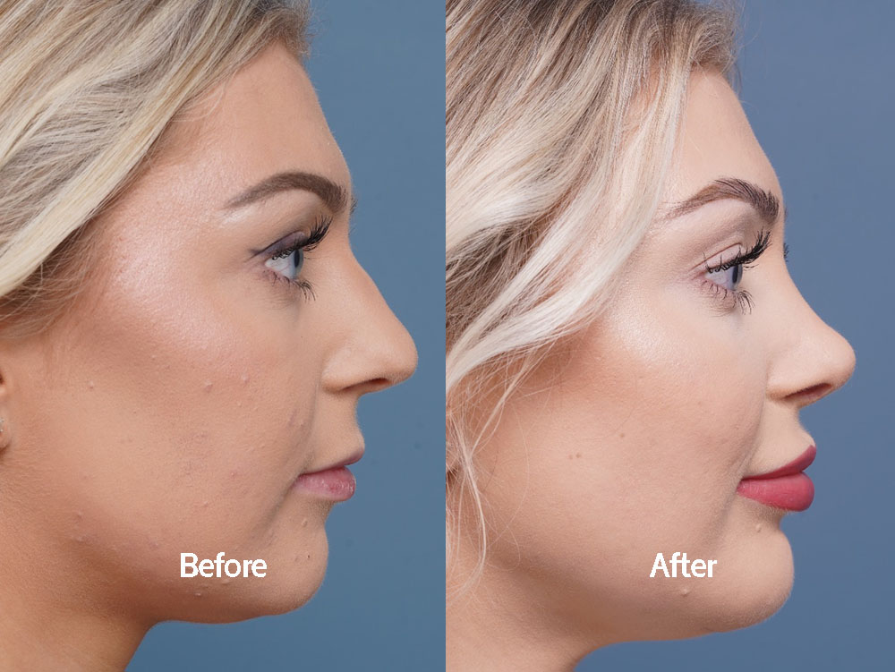 Dr. Justin Bellamy is a Plastic surgeon specializing in Rhinoplasty