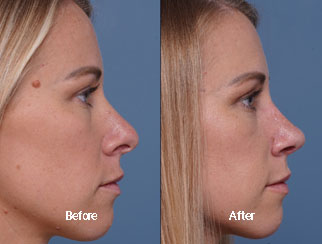 Before & After